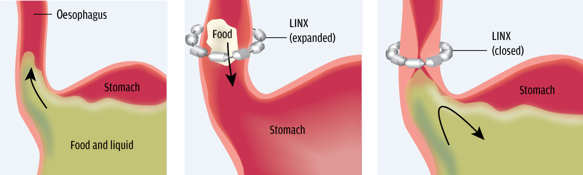 Acid Reflux Linx System